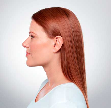 Eliminate Your Double Chin with Kybella in NYC - After2