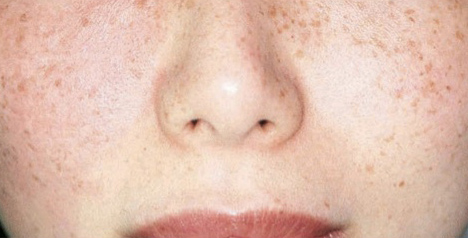 Sun damage/hyperpigmentation face