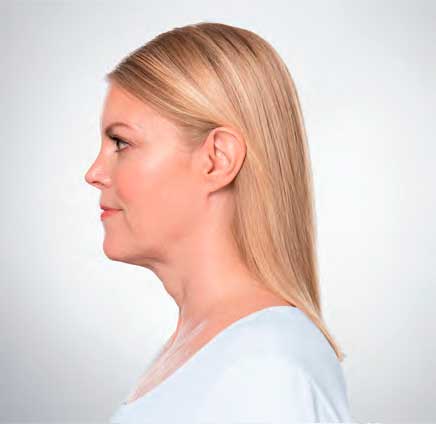 Eliminate Your Double Chin with Kybella in NYC - After
