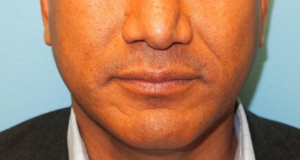 Before Injection of Nasolabial Folds/Smile Lines with Dermal Filler