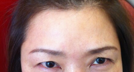 After Botox Injection of Forehead Lines