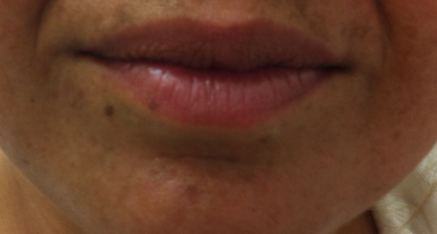 After Dermal Filler to Enhance Lips