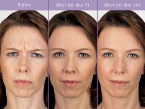 Botox treatment for Frown Lines before and after photo