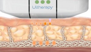 BEAUTY AND HEALTH. What is Ultherapy?