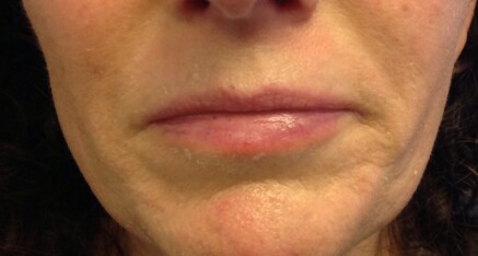 Before Dermal Filler for Smile Lines & Upper Lip Enhancement