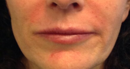 After Dermal Filler for Smile Lines & Upper Lip Enhancement