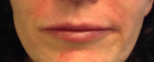 After Dermal Filler for Smile Lines & Upper Lip Enhancement