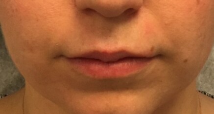 After Dermal Filler for Lip Enhancement