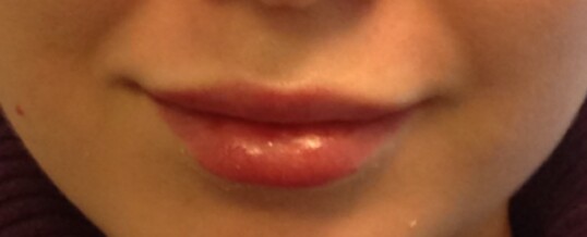 After Dermal Filler for Lip Enhancement