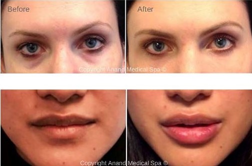BEAUTY AND HEALTH. Dermal Fillers and Botox - Before and After Treatment Photos: female