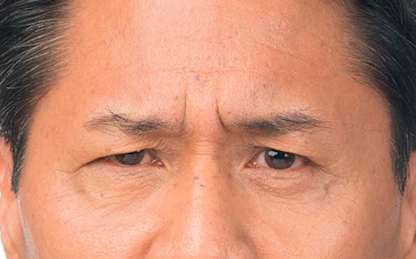 BOTOX FOR WRINKLES - Before Treatment Photo:Female (frontal view)