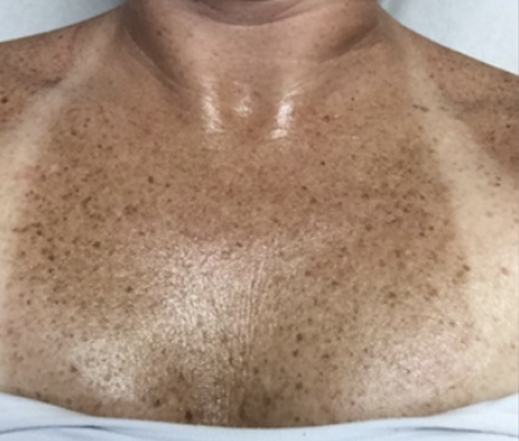 Sun damage chest treatment