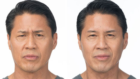 BOTOX FOR WRINKLES - Before Treatment Photo:Female (frontal view)
