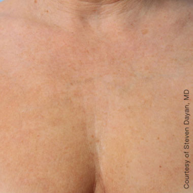 Eliminate Your Double Chin with Kybella in NYC - After