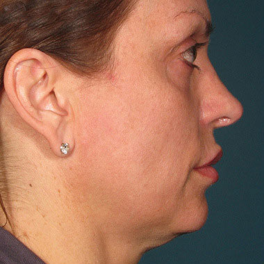 Eliminate Your Double Chin with Kybella in NYC - Before
